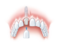 Implantologie Bild 1